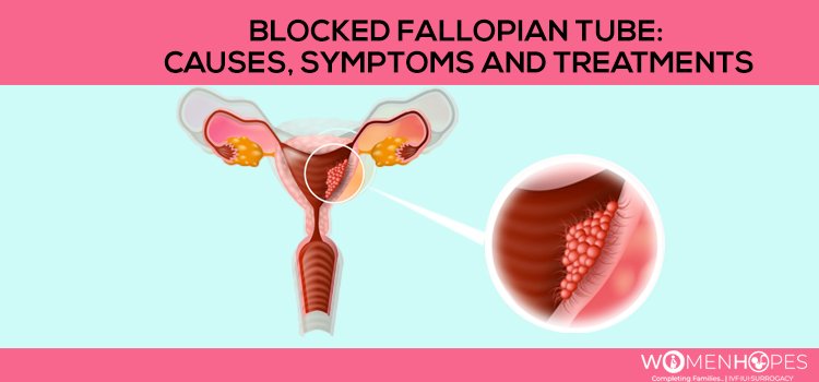 Blocked fallopian tubes: Symptoms, Causes and Treatments