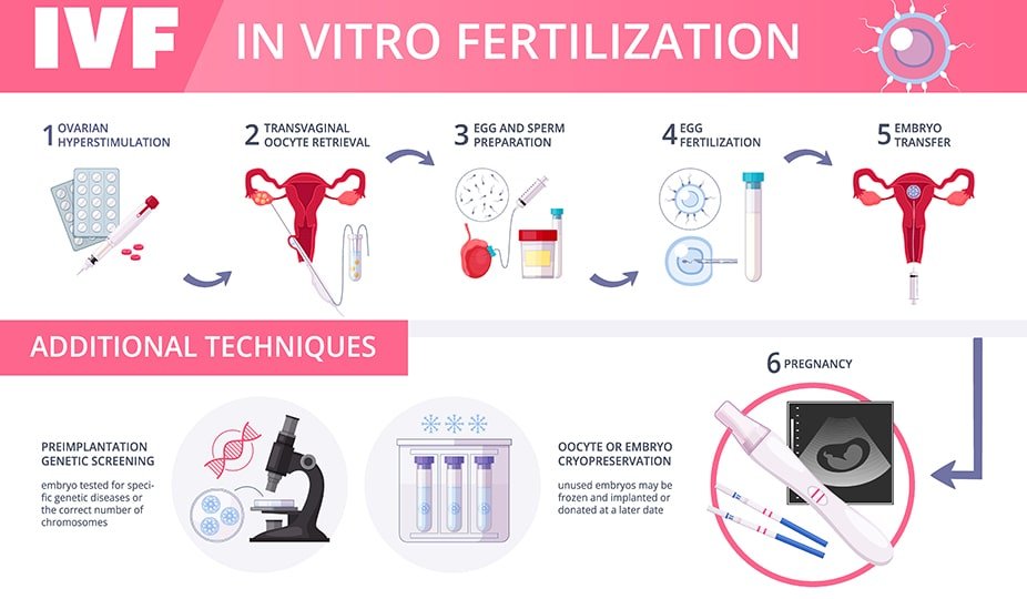 How is IVF Done—Step by Step process of IVF