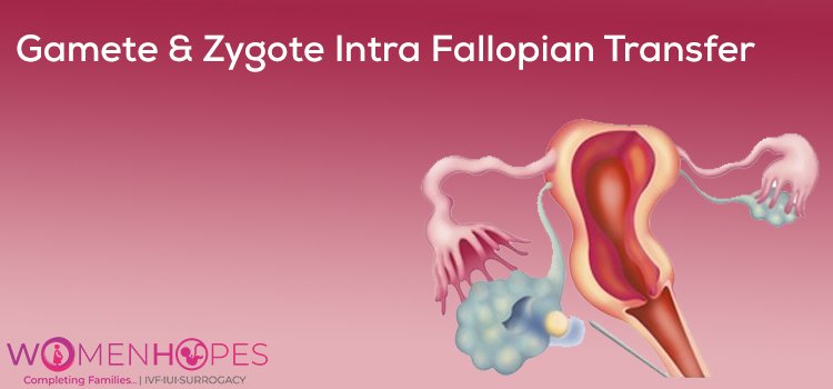 Gamete and Zygote Intrafallopian Transfer (GIFT and ZIFT)